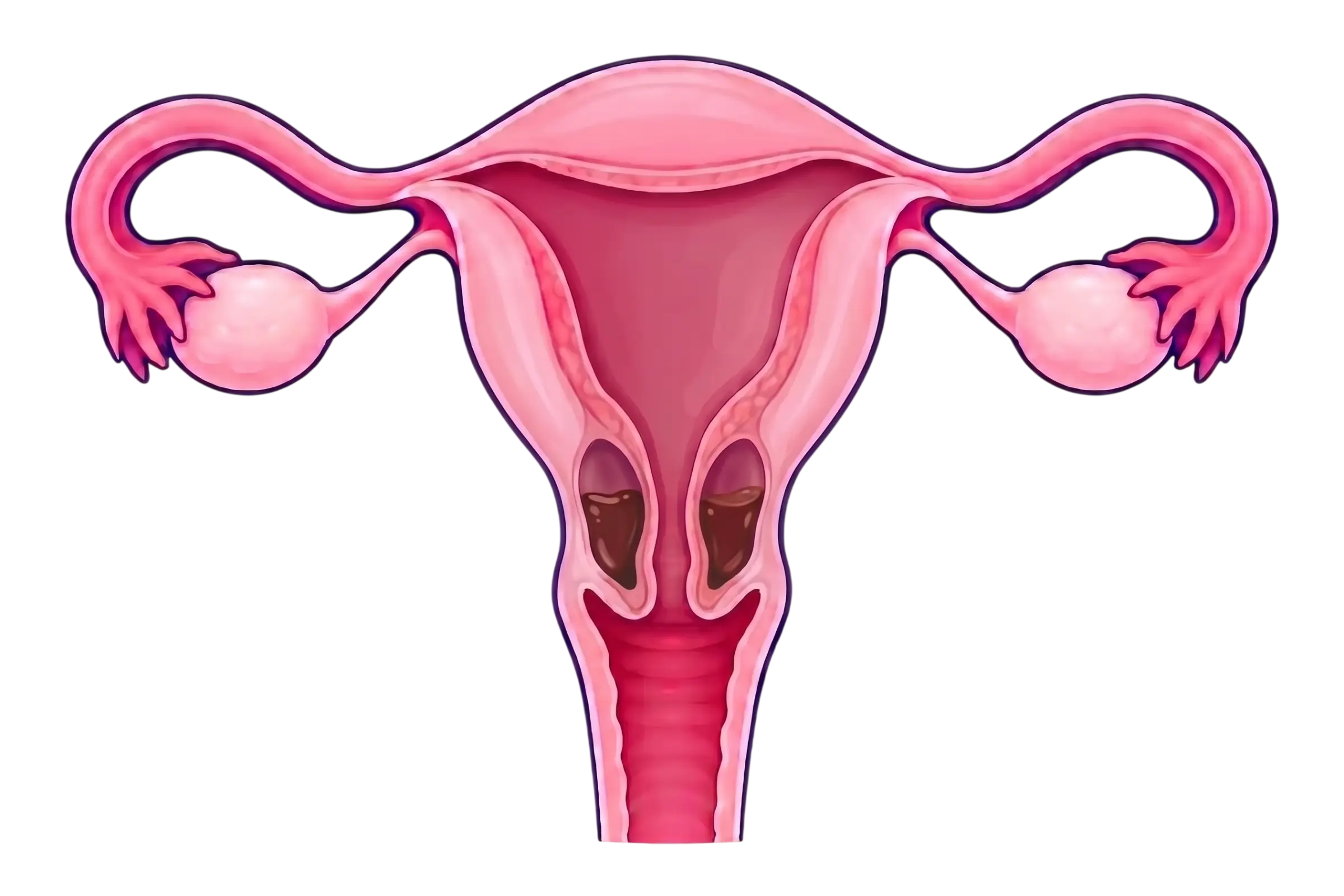 Istmocele