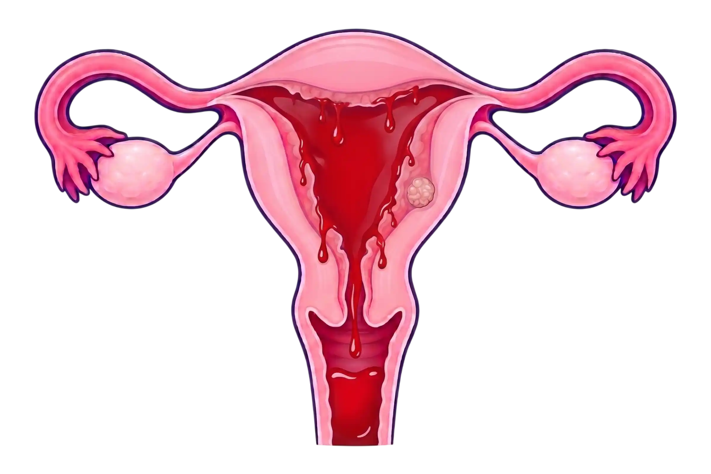 Sangrado uterino anormal y postmenopáusico